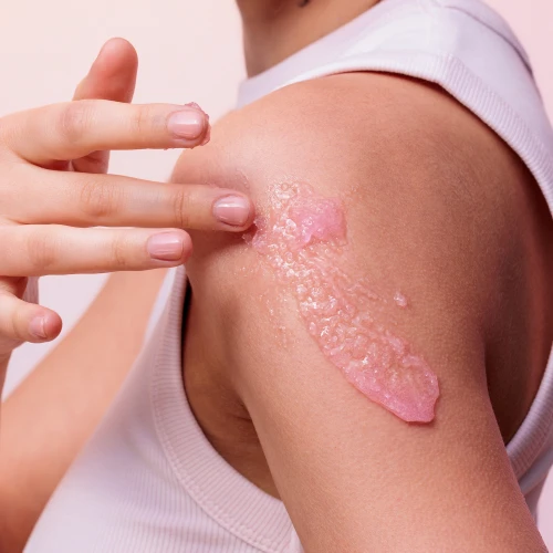 raspberry peeling_3.webp